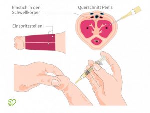 Schwellkörper-Autoinjektions-Therapie bei Impotenz