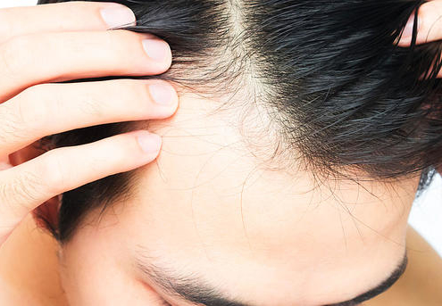 ᐅ Ursachen Behandlung Von Haarausfall Das Sollten Sie Wissen